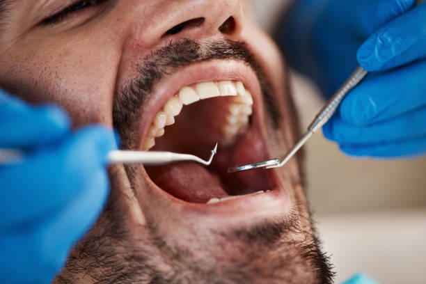 Best Emergency Tooth Extraction in West Canton, NC